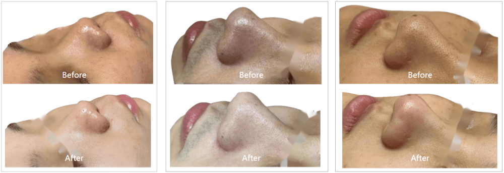 Comparison chart of facial machine usage results